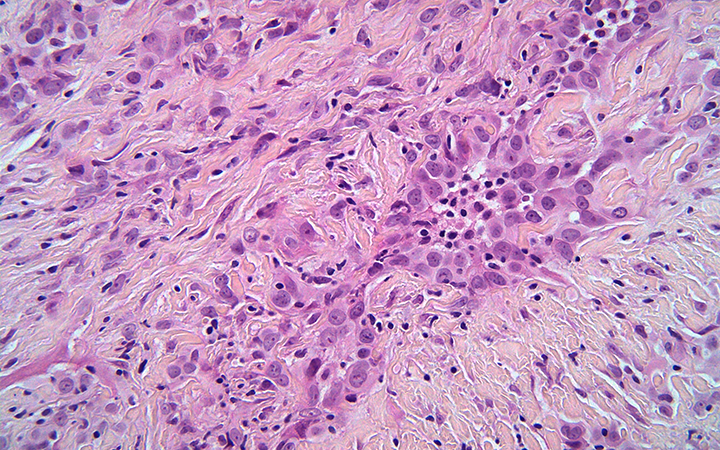 mesothelioma cells